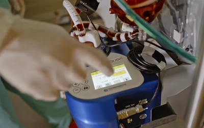 Logro Revolucionario en la Medicina: Primer Paciente Tratado con Colibrí, el Sistema de Soporte Vital Extracorpóreo más Ligero de Eurosets